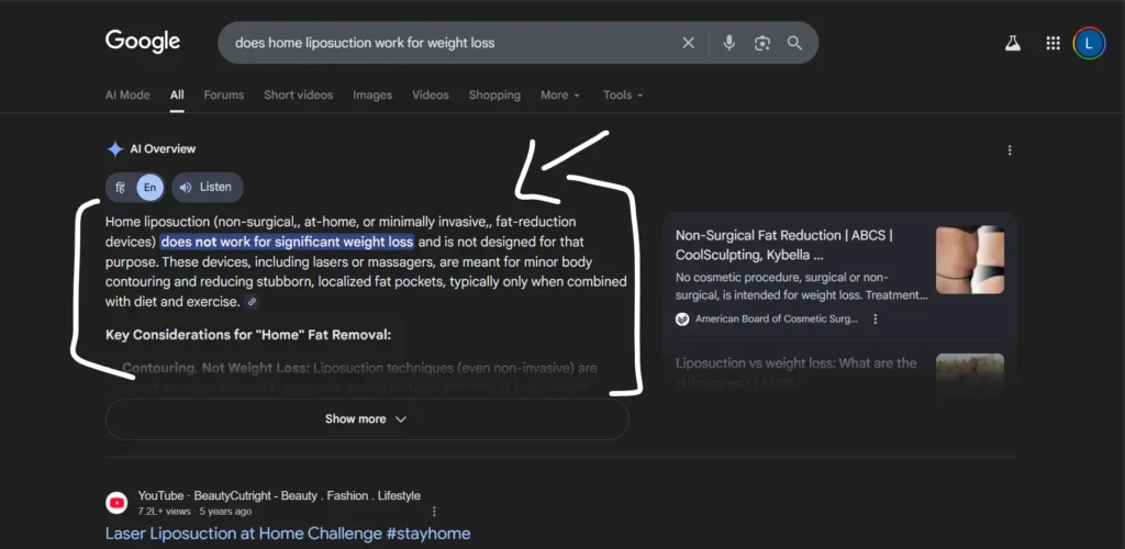 At-Home Liposuction Lipodyne
